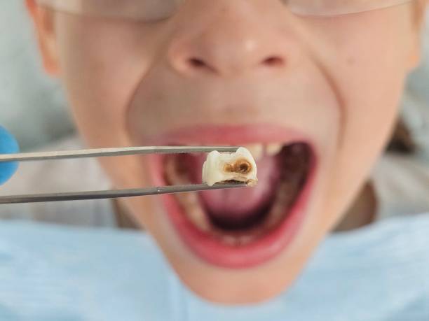 Best Emergency Root Canal Treatment in Berwyn, IL